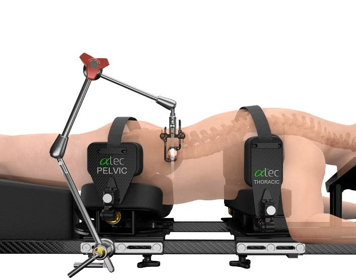 Case Example #2: Positional Saphenous and Posterior Tibial SSEP Changes During L2-4 Prone Transpsoas (PTP)&nbsp;Fusion