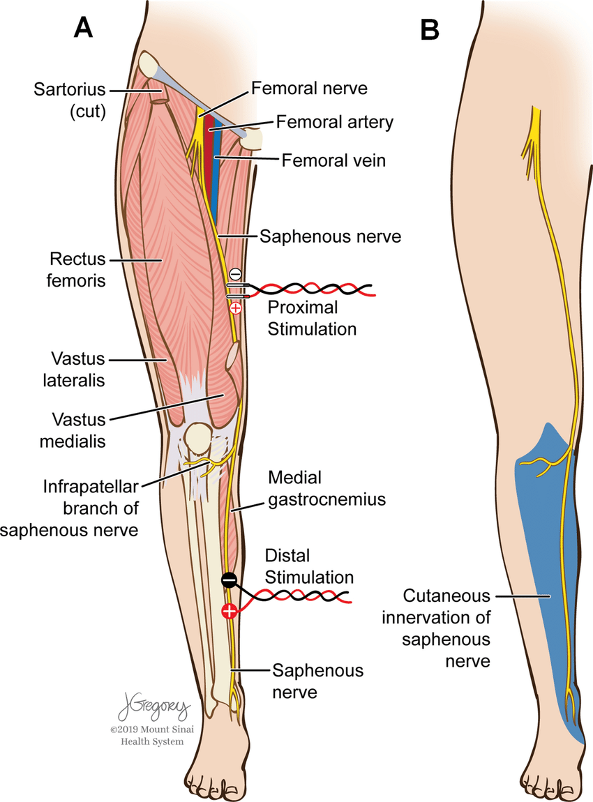 Case Example #1 – Positional Saphenous Nerve SSEP Changes During L3-4&nbsp;XLIF
